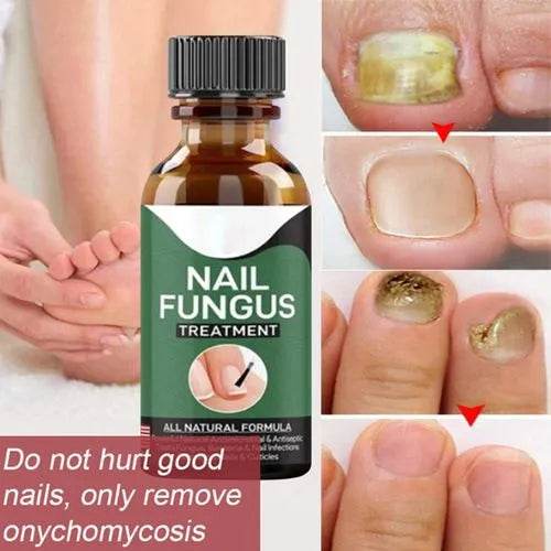 Nail Fungal Repair Serum | Nail Fungus Removal Gel - Raffa Store