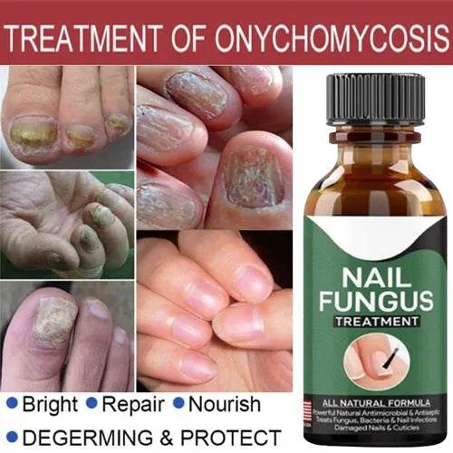 Nail Fungal Repair Serum | Nail Fungus Removal Gel - Raffa Store