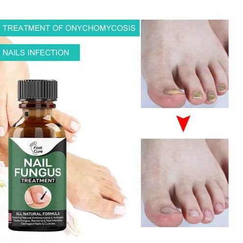Nail Fungal Repair Serum | Nail Fungus Removal Gel - Raffa Store